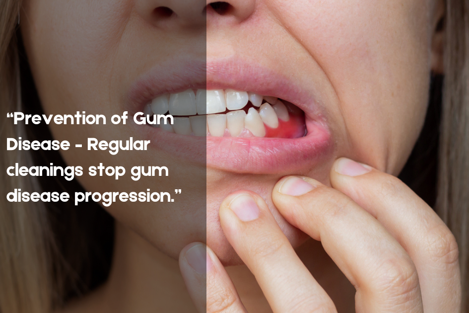 Illustration emphasizing gum disease prevention through regular cleanings at Pristine Family & Cosmetic Dentistry, San Antonio, TX.