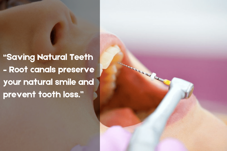 Illustration highlighting saving natural teeth with Root Canals, Pristine Family & Cosmetic Dentistry, San Antonio, TX.