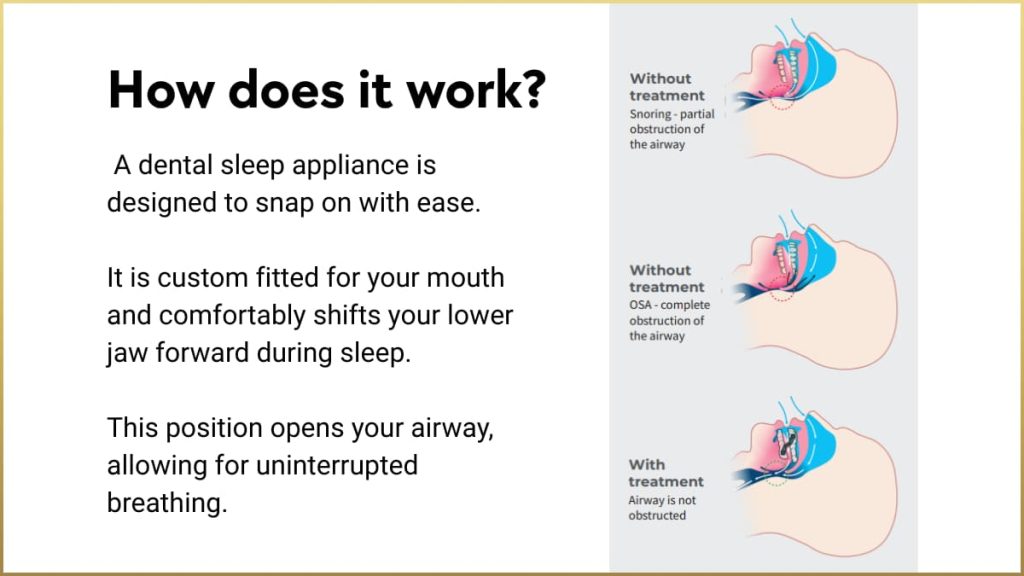 Dental sleep appliance shifts lower jaw forward to open airway, providing an effective sleep apnea and snoring treatment, as shown in illustrated side views comparing untreated and treated airway obstructions during sleep.